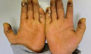 8歲小學生沉迷拍煙卡手指潰爛縮略圖