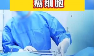 男子確診肺癌醫(yī)生一根針凍死癌細(xì)胞縮略圖 男子確診肺癌醫(yī)生一根針凍死癌細(xì)胞縮略圖