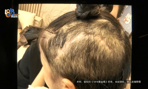 5歲女童游樂園頭皮撕裂頭骨露出縮略圖
