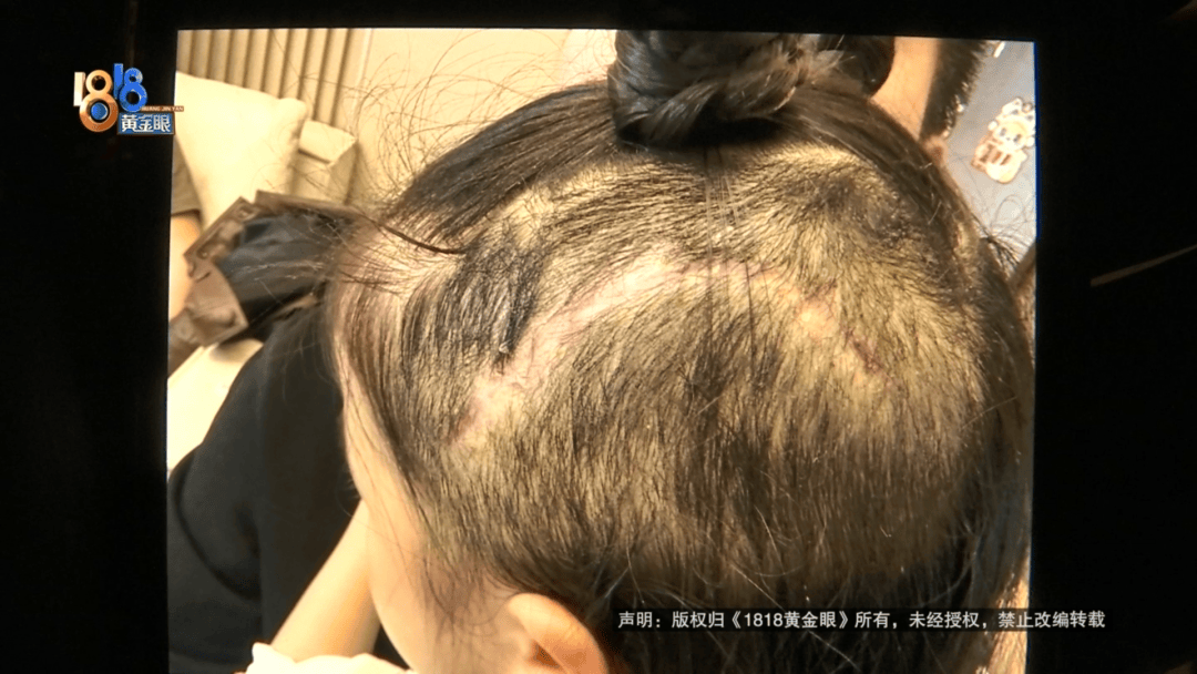 5歲女童游樂園頭皮撕裂頭骨露出插圖